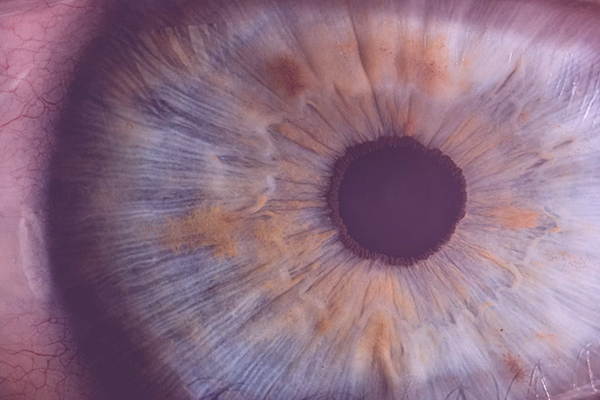 The Patient Experience of Ocular Myasthenia Gravis